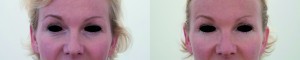 Patient 1 (left) Before treatment, and (right) 2 weeks post-treatment showing periorbital rejuvenation (improvement of crow’s feet and tear trough deformity)