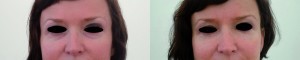 Patient 2 (left) Before treatment, and (right) 2 weeks post-treatment showing periorbital rejuvenation (reshaping of the eyebrows and correction of tear trough deformity)