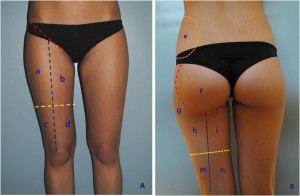 Figure 1 It is important to identify some landmarks in order to analyse the areas to treat. (left) Anterior view: red line = inguinal ligament; blue line = line from mid-inguinal ligament to knee; yellow line = anterior mid-thigh line. Area a = superoexternal thigh; area b = superointernal thigh; area c = inferoexternal thigh (external knee area); area d = inferointernal thigh (internal knee area). (right) Posterior view: red line = contour of buttock; orange line = contour of hip; green line = contour of trochanter; blue line = line from buttock fold to popliteal; yellow line = posterior mid-thigh line. Area e = hip adipocity area; area f = buttock area (muscle area); area g = trochanter adipocity area; area h = external superior thigh; area i = internal superior thigh; area m = inferior external thigh (external popliteal area); area n = inferointernal thigh (interior popliteal area)