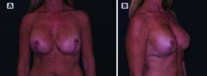 Figure 4 (A) 3 weeks postoperative result following replacement of implants in the sub-fascial position with mesh support and (B) 3 weeks postoperative, lateral view