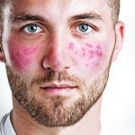 Rosacea: the strawberry fields of dermatology