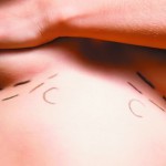 Breast augmentation number 1 in US