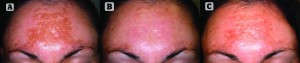 Figure 2 Phototype III, 27-year-old female patient with a 3-year evolution of melasma (A), which was resistant to topical treatments. Alternative treatment was performed using FT pulsed light with 520 nm filter, 14.5 J energy and 2-pulses emission with Ton: 4 and 5. Good results were achieved after 6 days of treatment (B). Partial repigmentation can be seen after 30 days (C). The patient was satisfied and two additional sessions have been scheduled to reduce pigmentation