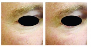 Figure 1 Male patient, aged 40Â years, (A) before treatment and (B) 1 month post-treatment. The treatment was carried out using the Revive mn (amiea med, MT.DERM GmbH, Berlin, Germany), Revive-HAP, 6-point needle plate
