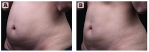 Figure 2 Treatment with Liposonix (A) before and (B) 12 weeks post-treatment, showing a 4.05 cm reduction (Images courtesy Solta Medical Aesthetic Center)