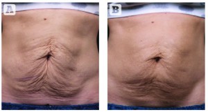 Figure 3 Treatment with Thermage (A) before and (B) 3 months post-treatment. (Images courtesy of Solta Medical Aesthetic Center)