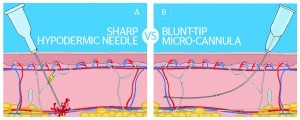 Figure 1 Penetration of a sharp needle (A) and microcannula (B) through tissue structures. Image A illustrates how a sharp needle pierces a blood vessel, while image B shows a blunt-tip microcannula that bends around a vessel