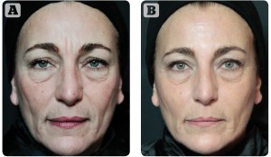 Figure 2 Full face treatment (A) before and (B) after 1 month with: Aliaxin® EV — malar area and jawline 1 ml per side, chin 1 ml; Aliaxin® SR — cheeks 0.5 ml per side, glabella 0.5 ml