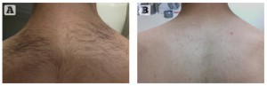 (A) Before and (B) after three treatment sessions. Hair removal with the CLARITY 755 nm Alexandrite laser. Images courtesy of Kubilay Yücel, MD, Turkey