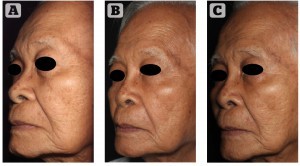 Figure 3 Patient 1 — two-dimensional images over time. (A) Before stem cell facelift, (B) 2 months, and (C) 7 months post-procedure