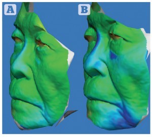 Figure 4 Patient 1 — three-dimensional colourimetric analysis demonstrating areas of volume change (blue) over time. Between (A) 2 months and (B) 7 months post‑procedure. The 83 year-old male was very pleased with the results