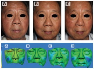 Figure 5 Patient 7 — top: series of two-dimensional images over time. (A) Pre-procedure, (B) 1 month after, and (C) 6 months after. Bottom: three dimensional colourimetric analysis demonstrating areas of volume change (blue) over time. Between (A) 24 hours, (B) 1 month, (C) 3 months, and (D) 6 months