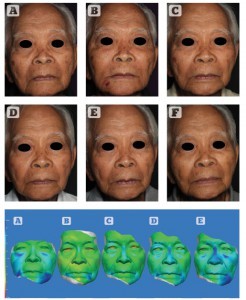 Figure 6 Patient 1 — top: series of two-dimensional images over time. Bottom: three-dimensional colourimetric analysis demonstrating areas of volume change (blue) over time. (A) 24 hours, (B) 1 month, (C) 2 months, (D) 3 months, and (E) 7 months. Between (B) month 1, and (E) month 7, there was a 205.95% increase on the left and 186.29% increase on the right