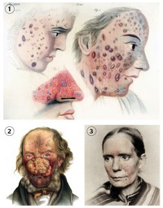 1 Acne rosacea illustration (Thomas Bateman, 1830)5 2 Acne rosacea illustration (Ferdinand von Hebra, 1869)5 3 Rosacea photograph (photogravure technique) (George Henry Fox, 1880)5