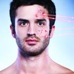 Laser and light-based therapies in acne vulgaris