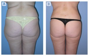 Figure 1 A) Before, and B) 3 months after six VASERshape treatments to the flank area. The pre-operative view also shows the left side immediately post treatment with immediate improvement