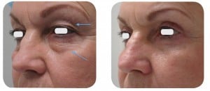 (Left) Baseline: A 61-year old female patient, skin type III. Presents symmetric and bilateral dermatochalasia on the upper lids. Pronounced static creases and lines on the lower lids, extending into the latera canthal area. (Right) Postoperative Results: 6 months post one session. The entire ellipse of skin was elevated and incised with laser. A thin strip of orbicularis oculi muscle was excised in order to expose the orbital septum. The defect in the orbital septum was identified, and herniated orbital fat was exposed. The abnormally protruding positions in the medial with laser and the stalk meticulously cauterized with laser. Afterwards, a single pass of the AcuPulse™ AcuScan120™ in Combo mode was used to resurface the lower lid complex.