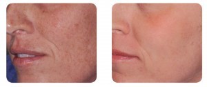 (Left) Baseline: 36-year old female patient, skin type II. Presents dyschromia, elastosis and rhytids. (Right) Postoperative Results - 3 months post one session with IPL and AcuPulse™ (M22TM IPL followed by AcuPulseTM FeatherTouchTM mode, using the 200 mm grey handpiece with the SurgiTouch™ scanner, 24 W).