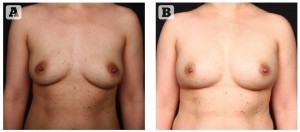 Figure 1 (A) Preoperative view of 35 year old female with BRCA positive gene. (B) A 1 year postopeartive view of the patient following two stage reconstruction with expander, Alloderm (LifeCell Corporation, Bridgewater, NJ), and injection of Botox (Allergan, Irvine, CA) at first stage followed by placement of Natrelle 410 MF implants (Allergan, Irvine, CA) and fat injection. © Courtesy of Allen Gabriel, MD