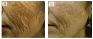 Figure 2 Severe photodamage and laxity in a 65-year-old Turkish female, Fitzpatrick skin type III. (A) Baseline findings. (B) 4 months after the final treatment session. Three MFR treatment sessions were given, 2 weeks apart, and three passes per session.