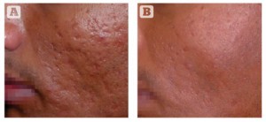 Figure 3 Acne scarring (rolling and box car type) on the cheek of a 37-year-old Indian male, Fitzpatrick skin type IV. (A) Baseline findings. (B) 1 month after a single MFR session, three passes (two passes over the whole face and one further pass over the scars).