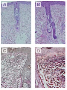 Figure 6 Histologic assessments of changes in collagen and elastin 2 weeks after eight sessions of 830 nm LED-LLLT monotherapy over 4 weeks. (A) Haematoxylin and eosin staining showing the condition of collagen at baseline. (B) 2 weeks post final treatment. A significant increase is seen in the amount and quality of collagen, with a very well-oriented Grenz layer, a thicker and more cellular epidermis, and well-organised stratum corneum. (C) Verhoeff-van Giesen stain showing the condition of the elastic fibres at baseline. (D) Findings 2 weeks after the final treatment. A significant increase in the amount and quality of elastic fibres is noted at all depths in the dermis, a thicker epidermis and well-formed stratum corneum. All at original magnification X 200.