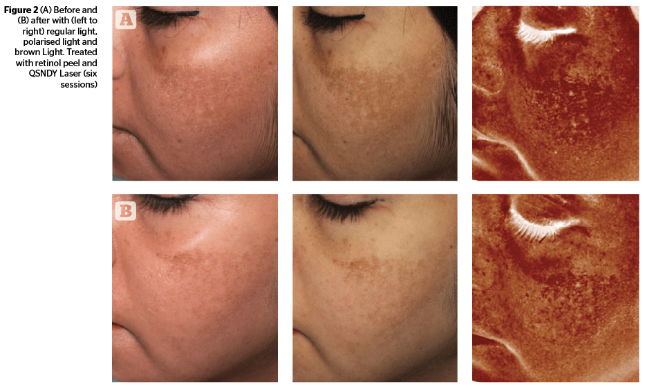 ipl skin rejuvenation reviews