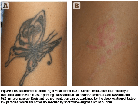 laser tattoo removal reviews the best tattoo 2017 laser tattoo removal reviews the best tattoo 2017