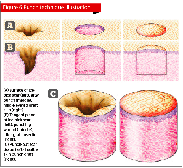 Management of Post-acne Scarring | PRIME Journal
