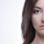 Management of Post-acne Scarring