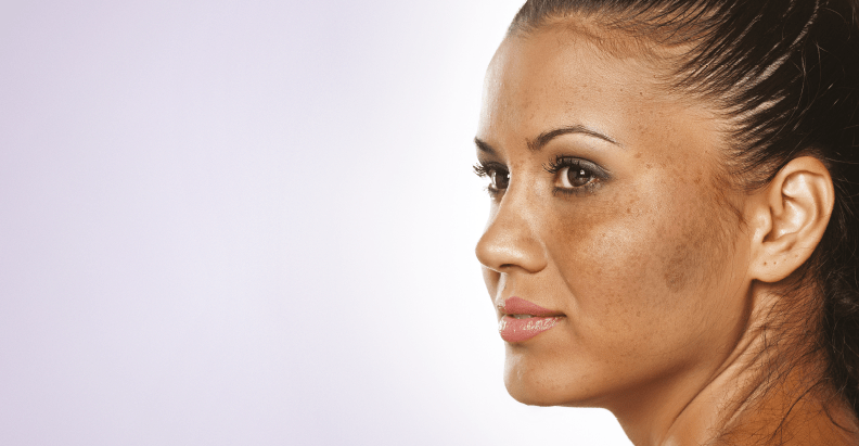 Melasma aetiology and treatment review | PRIME Journal