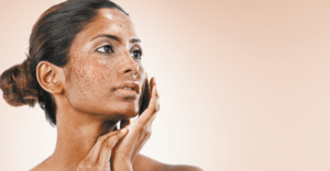 Facial hyperpigmentation in skin of colour