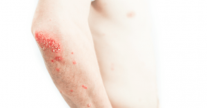 International Council Of Dermatologists Introduces New Method Of Determining Psoriasis Severity